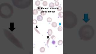 Sickle cell anemia under microscope Blood smear hematology Hematopathology worldsicklecellday [upl. by Isyad]