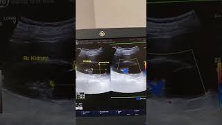 Cortical cyst in rt kidney ultrasound [upl. by Airetas]