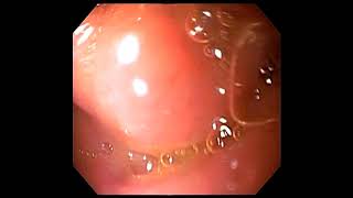 Normal oesophagogastroscopyDuodenitis withduodenal ulcer [upl. by Clere]