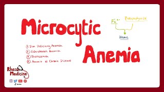 MICROCYTIC ANEMIA Iron Deficiency Anemia Anemia of Chronic Disease Sideroblastic Anemia  Rhesus [upl. by Largent]