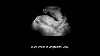 Placental Abnormalities vasa previa morbidly adherent placenta placental abruption [upl. by Amandie]