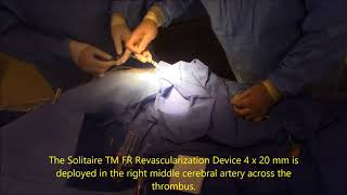 Mechanical thrombectomy for acute ischemic stroke [upl. by Yee38]