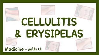 Cellulitis amp Erysipelas  clinical picture diagnosis amp treatment شرح عربي [upl. by Ahsineb]