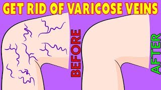 How to get rid of Varicose Veins naturally in 3 minutes a day [upl. by Ahsaetal]