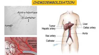 GASTROENTEROLOGIE tumeurs malignes du foie 2016 [upl. by Imef]