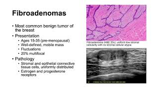 Fibroadenomas and Phyllodes Tumors [upl. by Anyl]