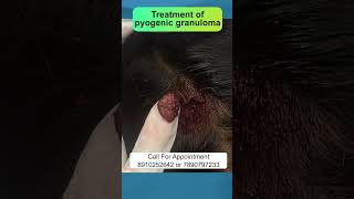 Treatment of pyogenic granuloma  By Dr Uttam Kumar Lenka MBBS MD Consultant Dermatologist [upl. by Yesmar]