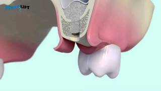 IntraLift® 3D by SATELEC® ACTEON® YouTube [upl. by Gerome]