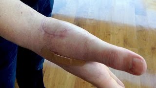 BREAKING MY THUMB LIGAMENT CHALLENGE AFTERMATHGRAPHIC PRANK DISGUSTING GROSS AF [upl. by Laurentia]