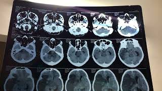 acute ischemic stroke with left sided hemiparesis [upl. by Drofnil965]