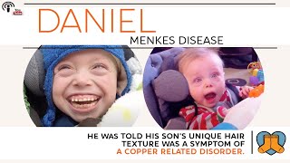 Daniel Menkes Disease [upl. by Ymmas834]