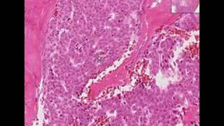 Histopathology OvaryGranulosa cell tumor [upl. by Hedy]