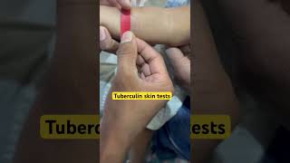 Tuberculin skin tests TST mediciane education baby MedicoAS [upl. by Dobson451]