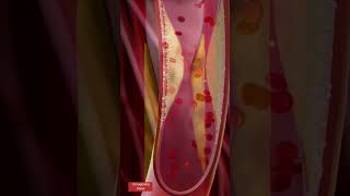 Angioplasty l Coronary artery Stenting l Animation heartattack shorts [upl. by Nnaillek130]