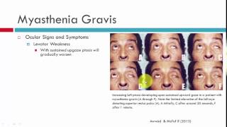 Myasthenia Gravis Clinical Characteristics [upl. by Alesiram]