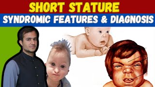 Syndromes  syndromic features and short stature in children [upl. by Yug610]