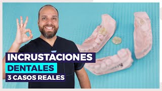 INCRUSTACIONES Dentales 😀 ¿Qué son Te lo explico con 3 CASOS REALES 🚀 [upl. by Eelirol]