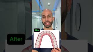 Invisalign to Close SpacesGaps and Open a Deep Overbite 2024 [upl. by Neeven812]