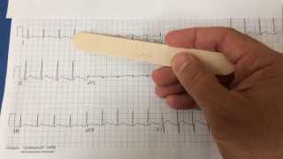 pericarditis on EKG [upl. by Jordain]