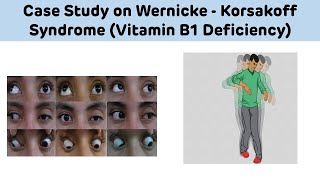 Case Study On Wernicke Korsakoff Syndrome Vitamin B1 Deficiency  Biochemistry Case Study [upl. by Tamara]