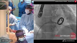 Mitral TTK Chithra Paravalvular Leak Closure [upl. by Aremaj885]