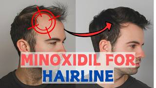 Minoxidil for Frontal Baldness  Restore Your Hairline [upl. by Vince]