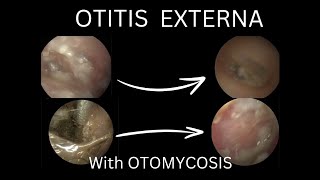 Otitis Externa with OTOMYCOSIS  2CASES  Cleaning Tips for Ear [upl. by Ulrike]