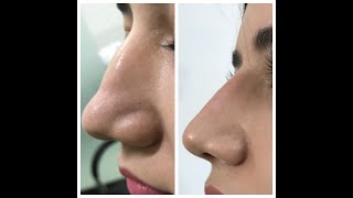 Non surgical rhinoplasty in lahore Pakistan by dr Saleem  best plastic surgeon at low cost [upl. by Leffert490]