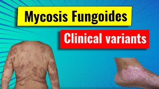 Clinical variants of Mycosis fungoides MF [upl. by Kimberly230]