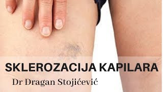 Uklanjanje proširenih kapilara skleroterapija sklerozacija vena cene cena cenovnik [upl. by Purington]