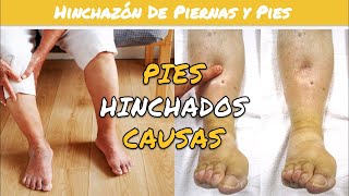 ⚕️🩺 HINCHAZÓN DE PIES Y TOBILLOS Causas y Recomendaciones [upl. by Nelleh]