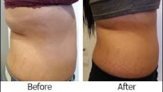 VelaShape cellulite treatment before and after [upl. by Skiba]