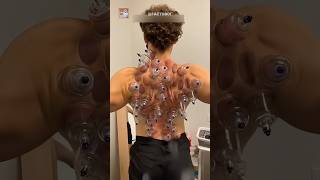 Cupping Theropy EXPLAINED 😱shorts [upl. by Nananne665]