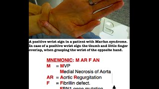 Marfan Syndrome Mnemonic [upl. by Sinnylg2]