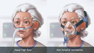 Nasal high‐flow therapy versus NIV in COPD patients with chronic respiratory failure [upl. by Irrac1]