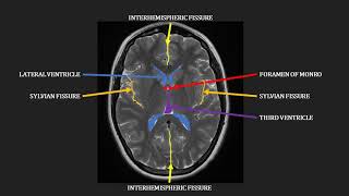 Introduction to MRI of the brain [upl. by Dareen]