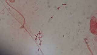 Gram negative bacteria in Gram staining of sputum [upl. by Esinehs248]