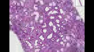 Histopathology KidneyRapidly progressive glomerulonephriti [upl. by Nadiya]