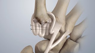 Osteoarthritis of the Thumb Surgical Treatment LRTI [upl. by Skylar180]