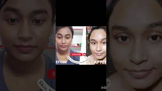 Skin Treatment Transformation shortsviral [upl. by Egoreg]