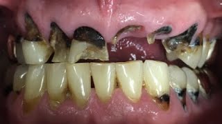 Meth Mouth  A Dentists Worst Nightmare Can It Be Treated [upl. by Reichert]