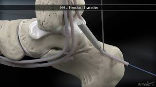 Flexor Hallucis Longus FHL Tendon Transfer [upl. by Lambert729]