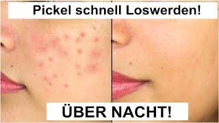 4 Hausmittel mit denen du PICKEL über NACHT loswirst [upl. by Plume889]