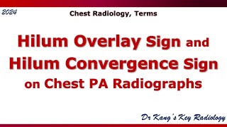 Hilum overlay sign and Hilum convergence sign [upl. by Elem562]