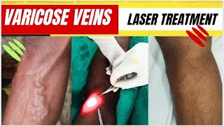 Laser treatment of varicose veins SSC GD medical  Varicose veins treatment Varicose vein laser [upl. by Baggett]