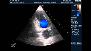 Insuficiencia Coronaria y Miocardiopatia Hipertrofica Septal Primariawmv [upl. by Eiddam]