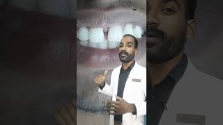 🦷FRONT TEETH GAP🔍 TREATMENT shortsfeed cosmeticdentistry shortsfeeds tamildentist dental [upl. by Nurat721]