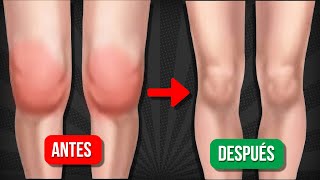 5 EJERCICIOS para DESINFLAMAR LA RODILLA y eliminar el LÃQUIDO [upl. by Desiree]