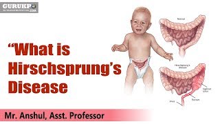 “What is Hirschsprung’s Disease” B Sc Nursing Pediatric Nursing Gurukpo [upl. by Cyb]