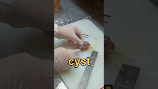 Cyst from the fallopian tube [upl. by Atiuqin]